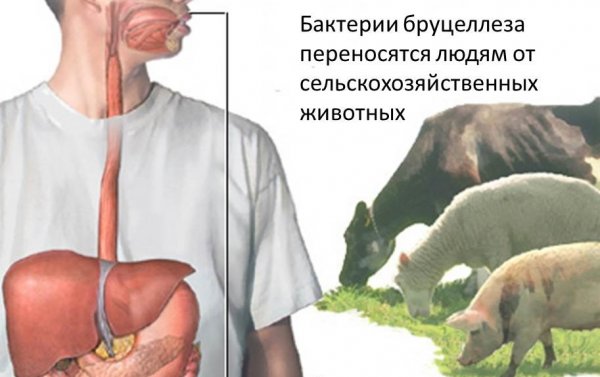 Бруцеллез